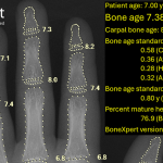 Visiana receives FDA<br>510(k) clearance for BoneXpert bone age software